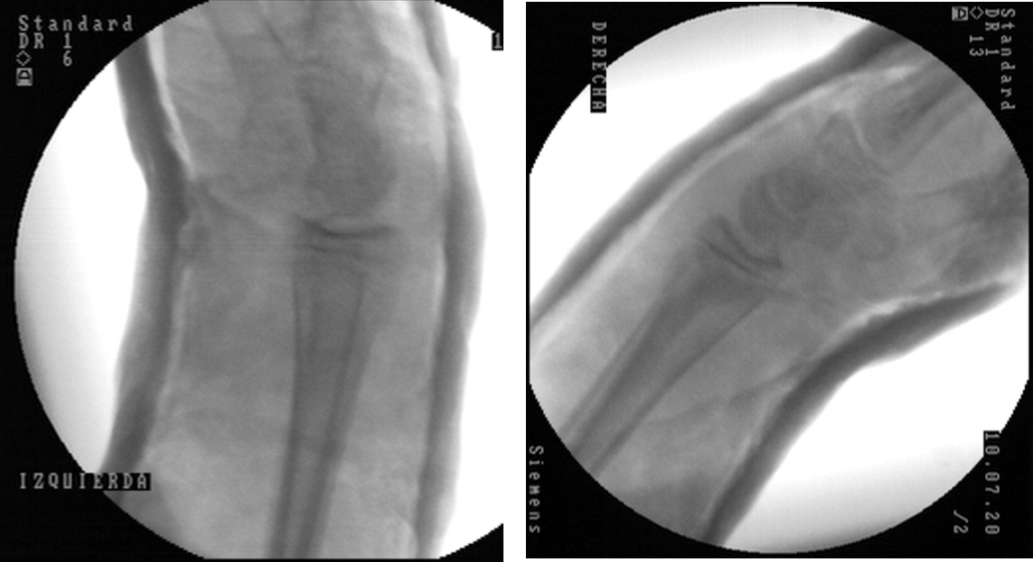 fractura de old varicoza